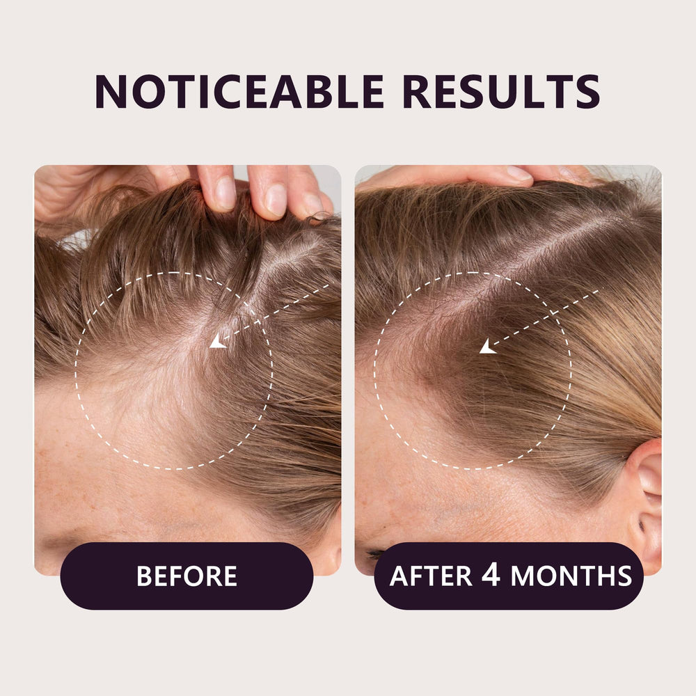 LONGCCI minoxidil 5% formula may support fuller-looking hair with consistency.