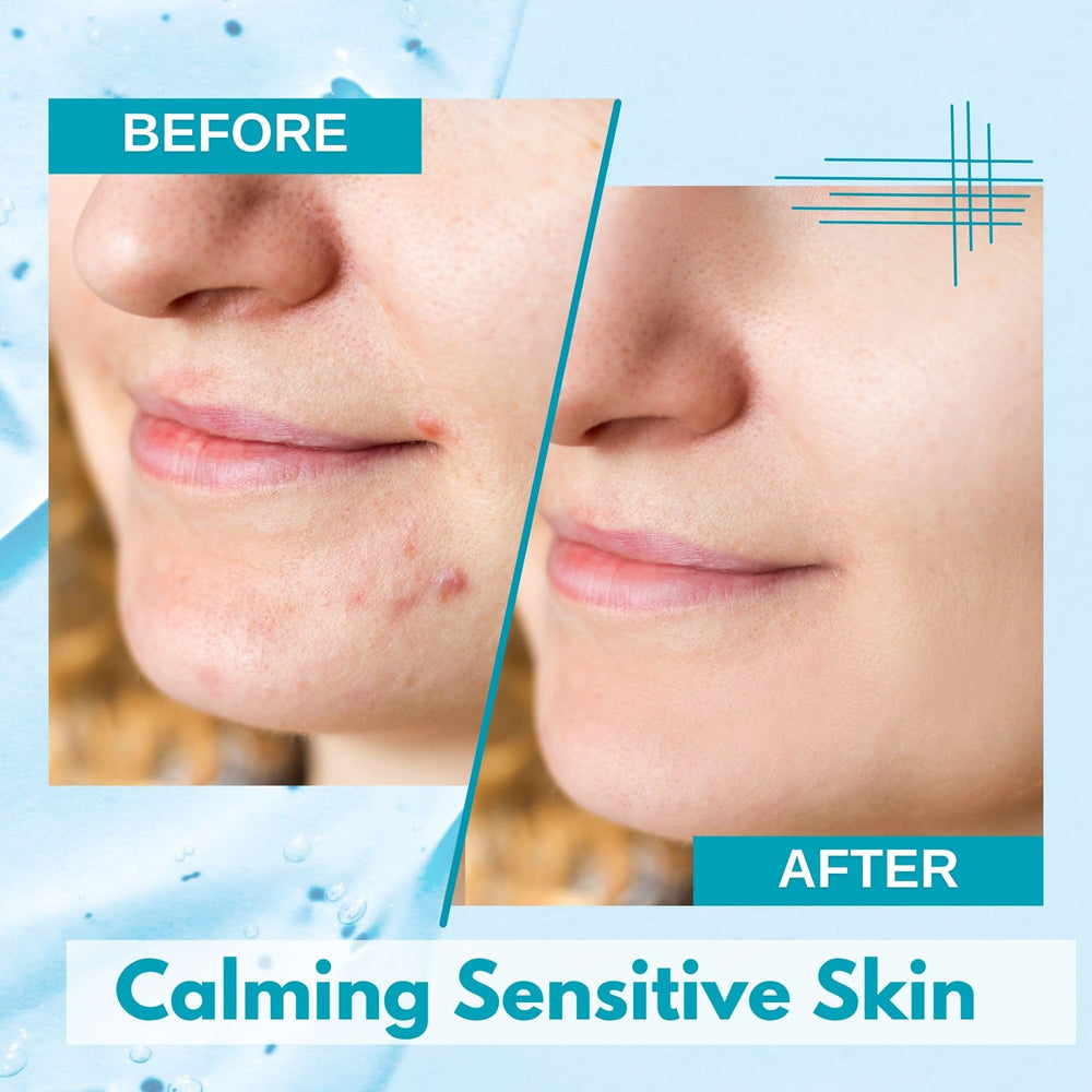 Lululun acne-prone skin mask with azelaic acid for pore-minimizing texture.