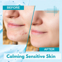 Lululun acne-prone skin mask with azelaic acid for pore-minimizing texture.