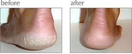 Luxuriant Cracked Heel Repair twin-pack tubes ready for quick, mess-free application.