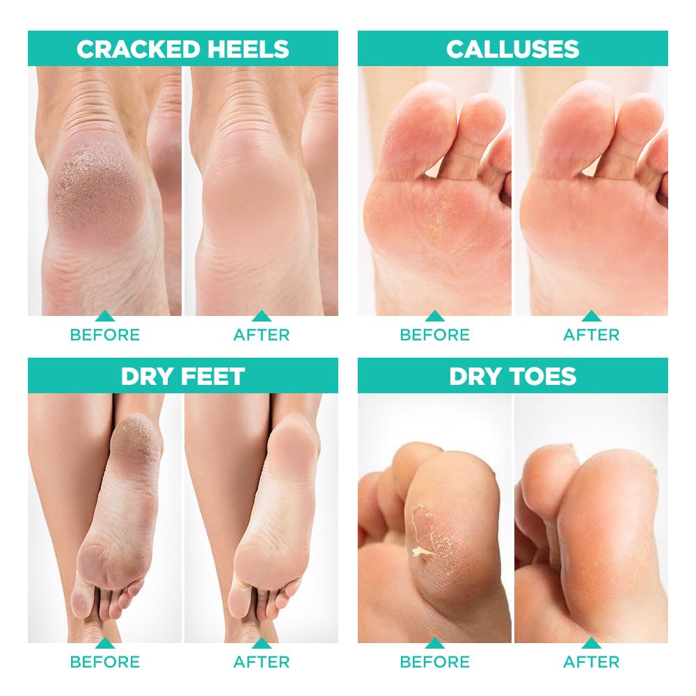 LV LAVINSO foot peel mask before and after showing smoother skin