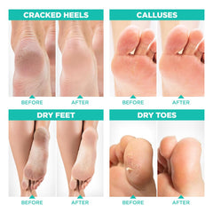 LV LAVINSO foot peel mask before and after showing smoother skin