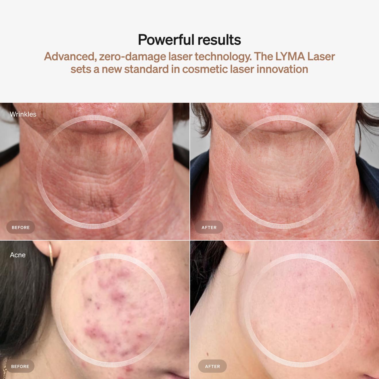 LYMA Laser Device with Oxygen Mist Glide, enhanced skincare routine compatibility.