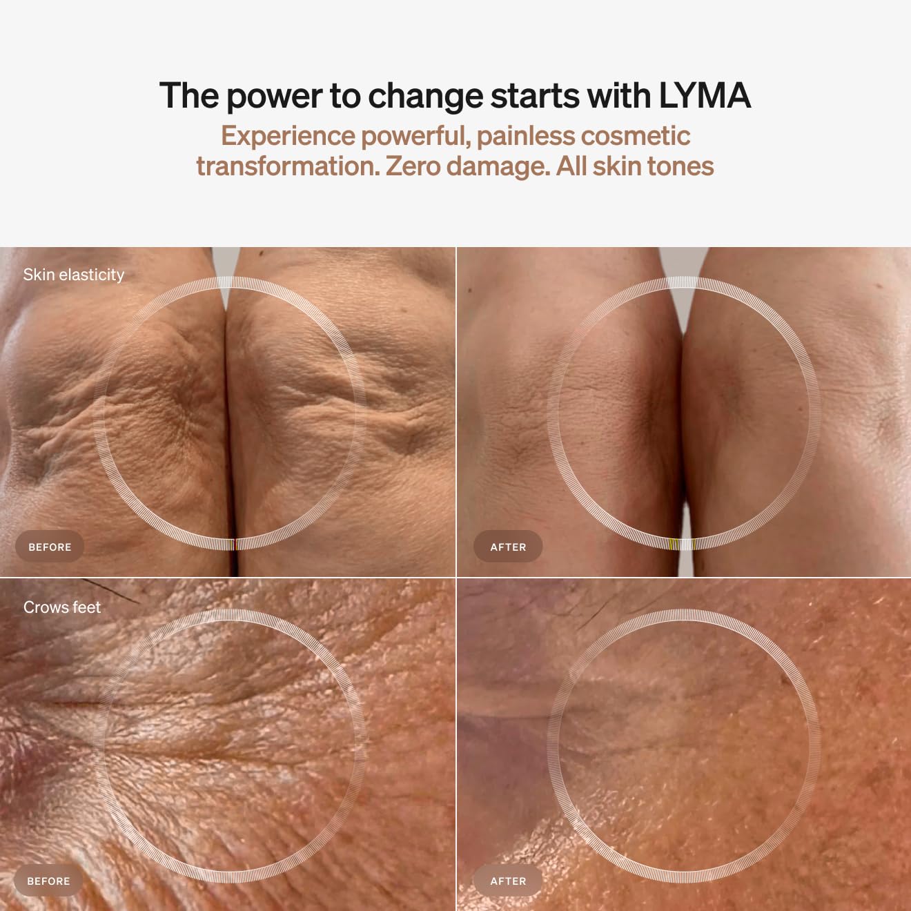 LYMA Laser Device portable design, travel-friendly option for on‑the‑go use.