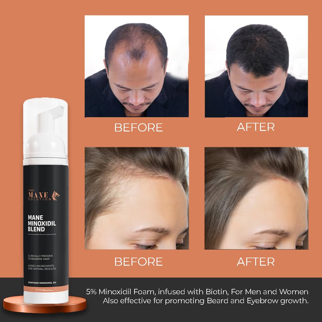 The Mane Solution Mane Minoxidil Blend Foam applied on scalp demonstrates quick absorption.