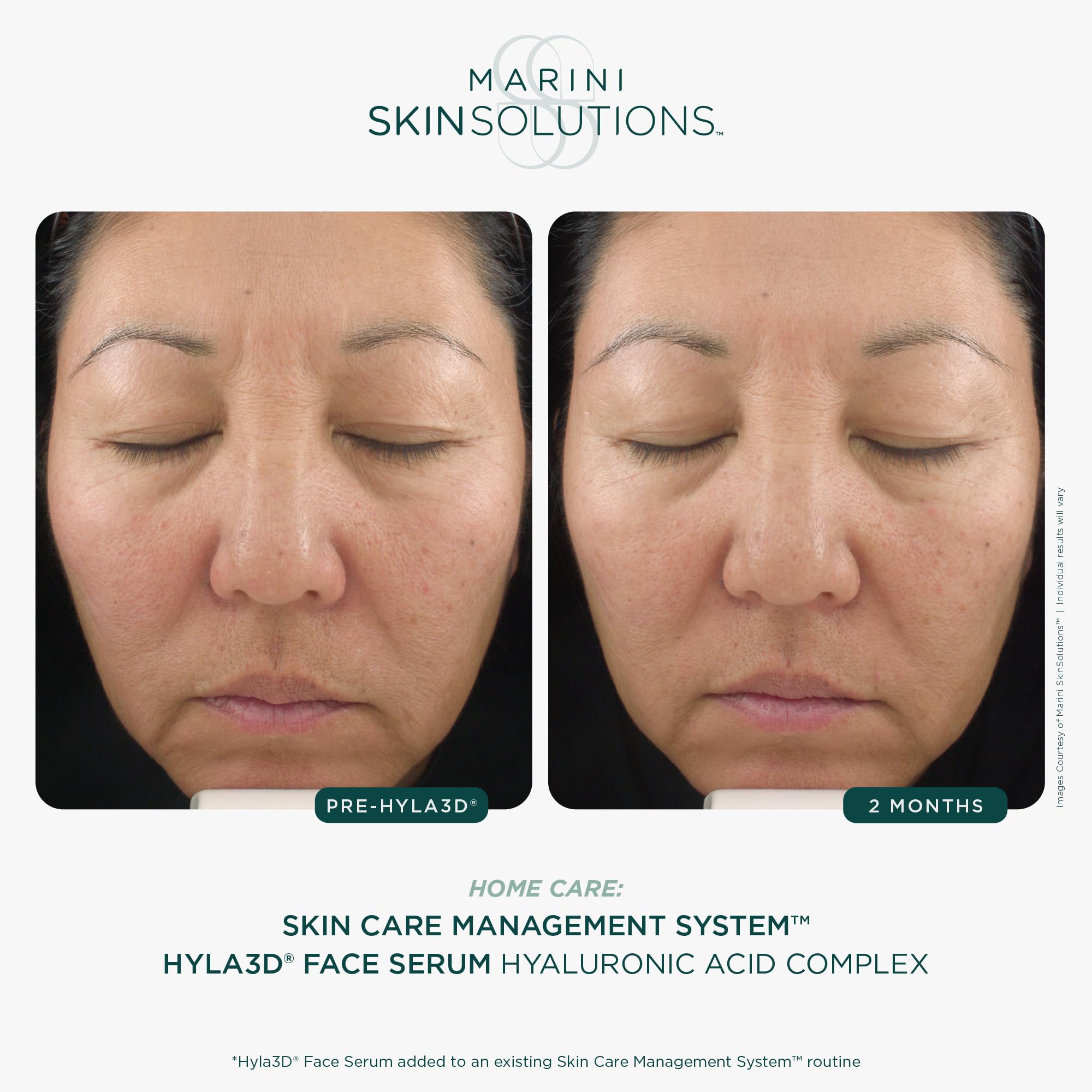 Marini SkinSolutions Hyla3D application view suggesting morning and evening use on the face and neck.