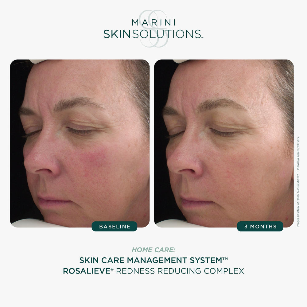Marini SkinSolutions RosaLieve tetrapeptide-14 smooths texture for a calmer complexion.