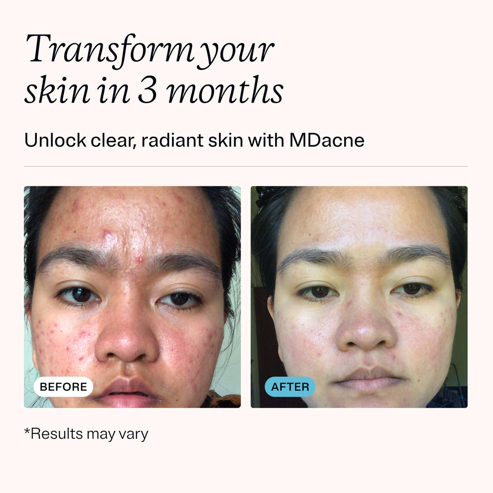 MDacne niacinamide moisturizer delivers light hydration and barrier support for calm skin.