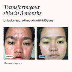 MDacne niacinamide moisturizer delivers light hydration and barrier support for calm skin.