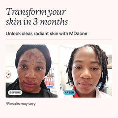 MDacne salicylic acid cleanser bottle emphasizes pore unclogging and oil control.