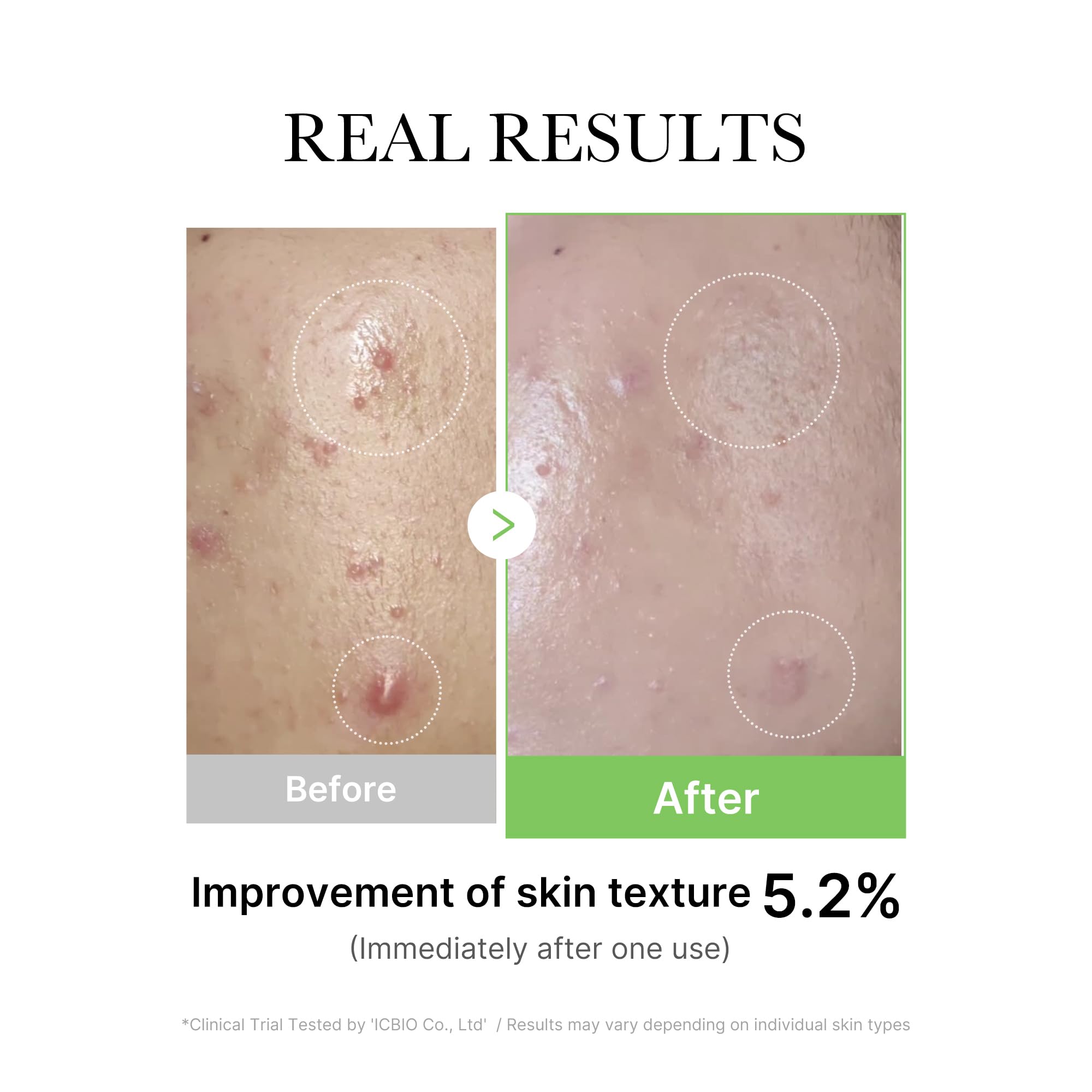 Medicube Exosome Cica Tea Tree Ampoule ingredients Centella Asiatica and Tea Tree water.