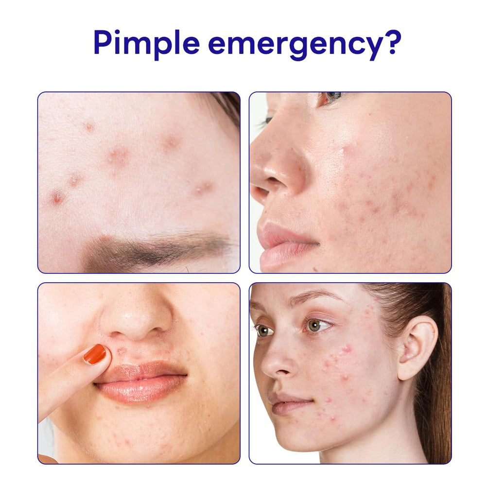 Mediheal Derma Clear patch absorbs yellow exudate around a blemish after squeezing.