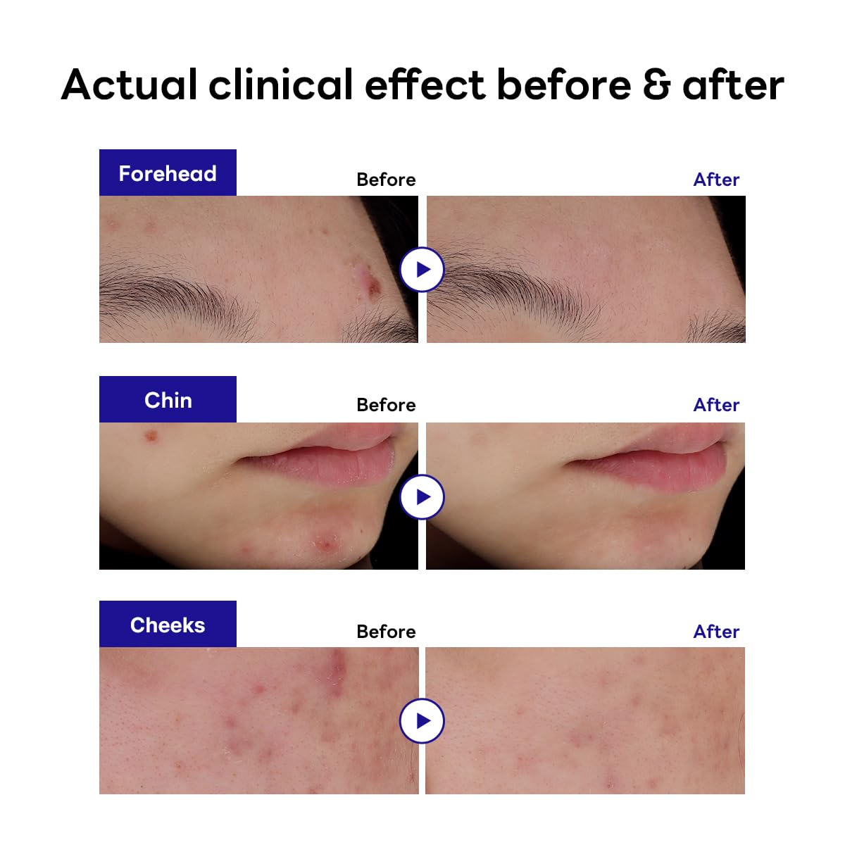 Mediheal Derma Clear patch with Madecassoside and Niacinamide soothes irritated skin and improves tone.