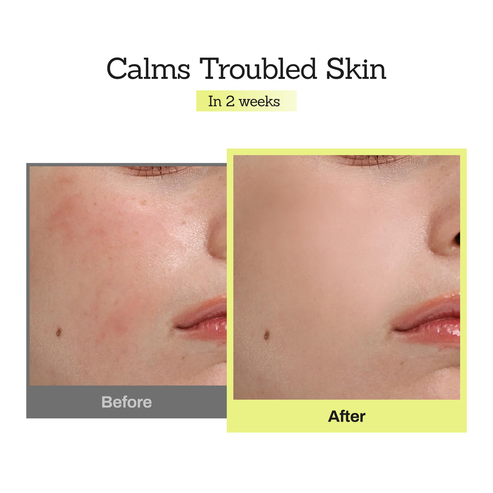 MEDITHERAPY Mugwort D-Panthenol 30 Calming Serum on skin demonstrates quick calming after toning.