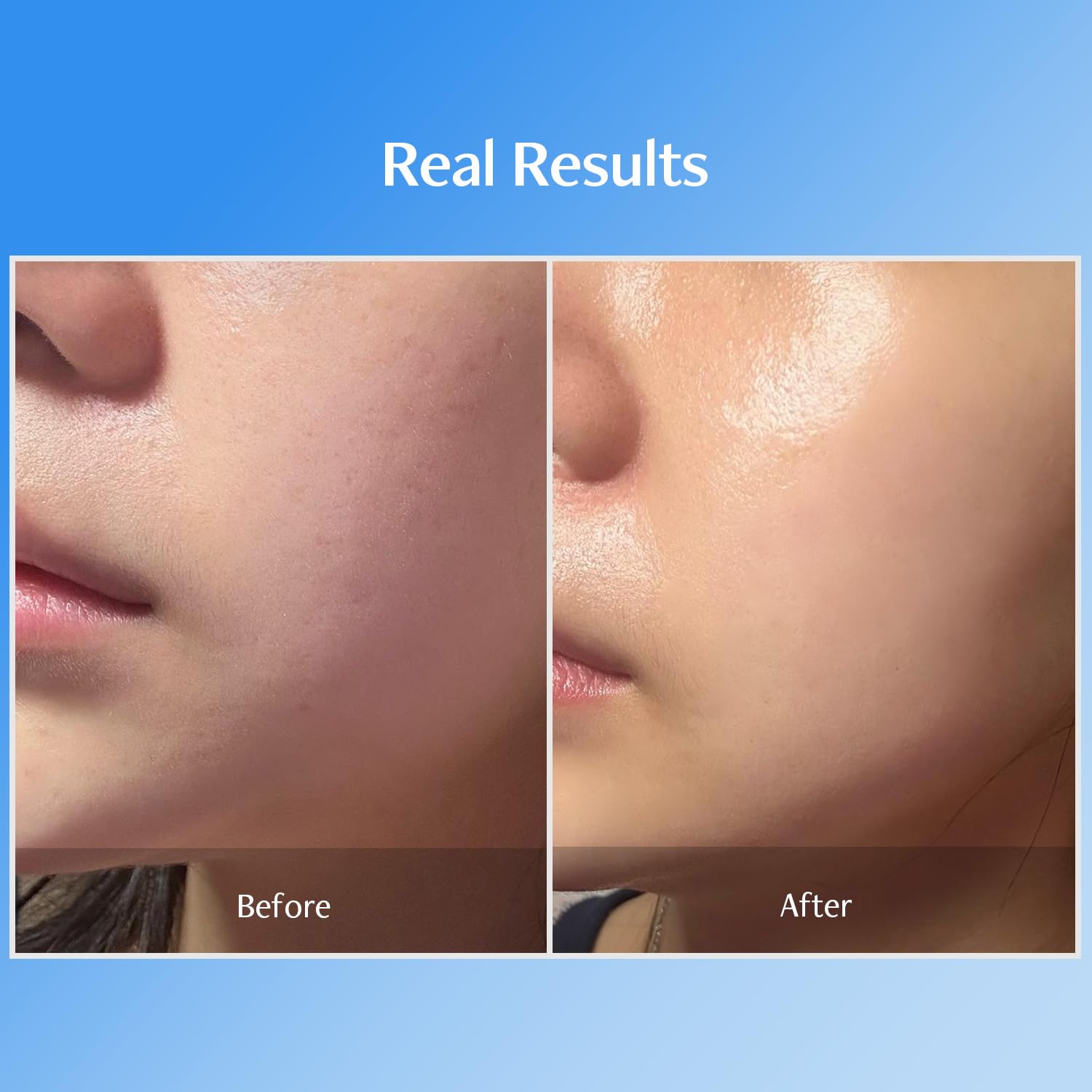 MEDITHERAPY Bluelayer nano-hyaluronic acid visualization signifies intense hydration.