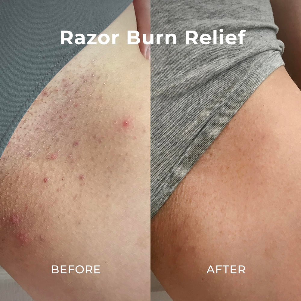 Miami Beach Bum razor burn relief spot in use