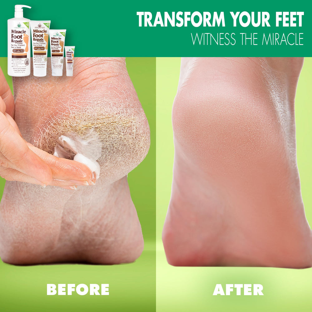 Close-up applying Miracle of Aloe on a heel for softening and comfort