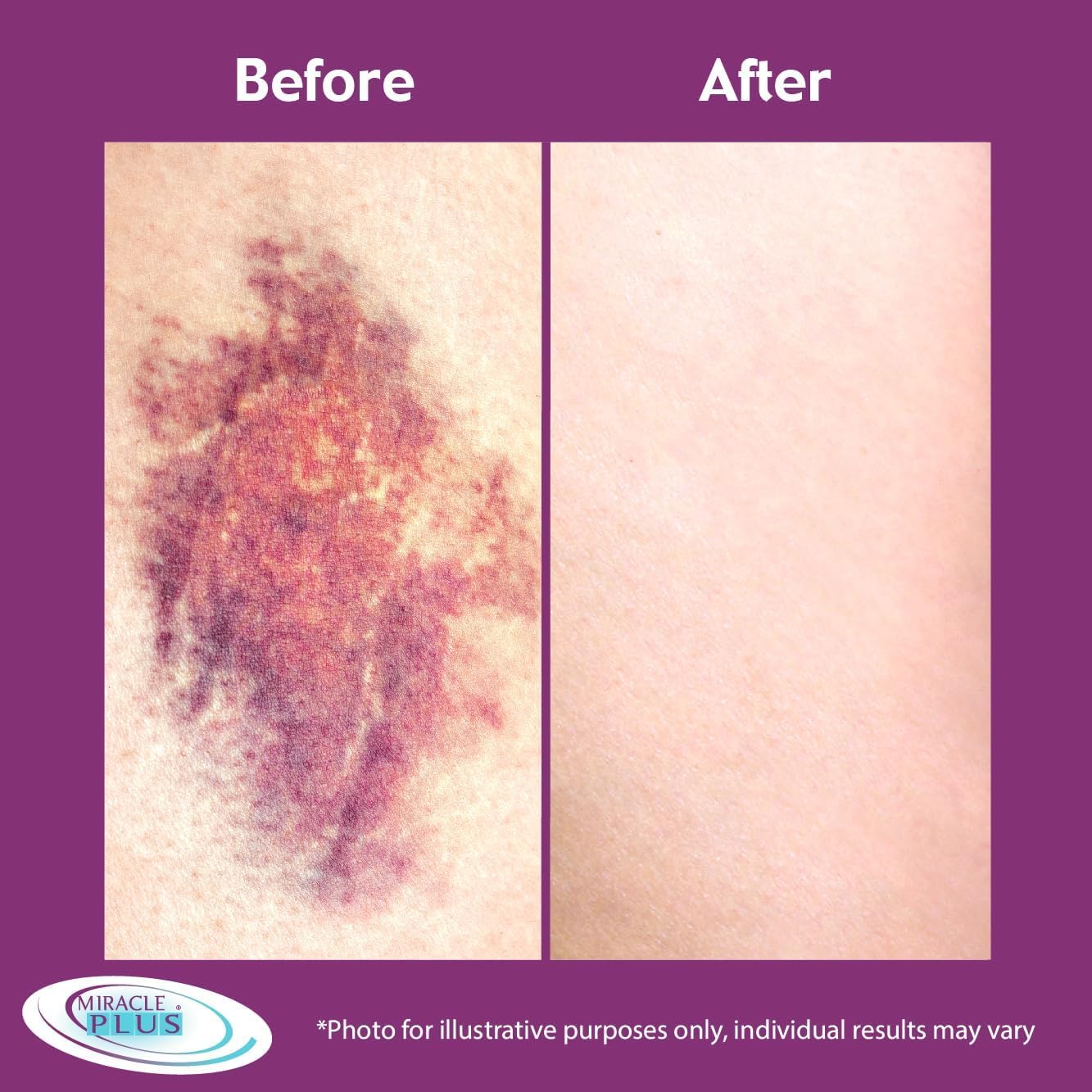 Miracle Plus Horse Chestnut extract shown on packaging