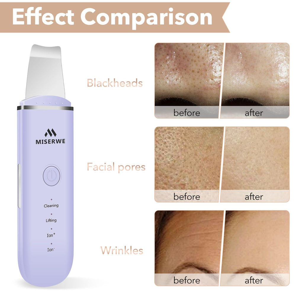 MISERWE Skin Scrubber Ion- mode for gentle exfoliation.