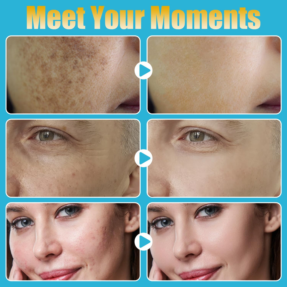 MONESAO Derma Roller Pen for beard area, smooth grooming support.