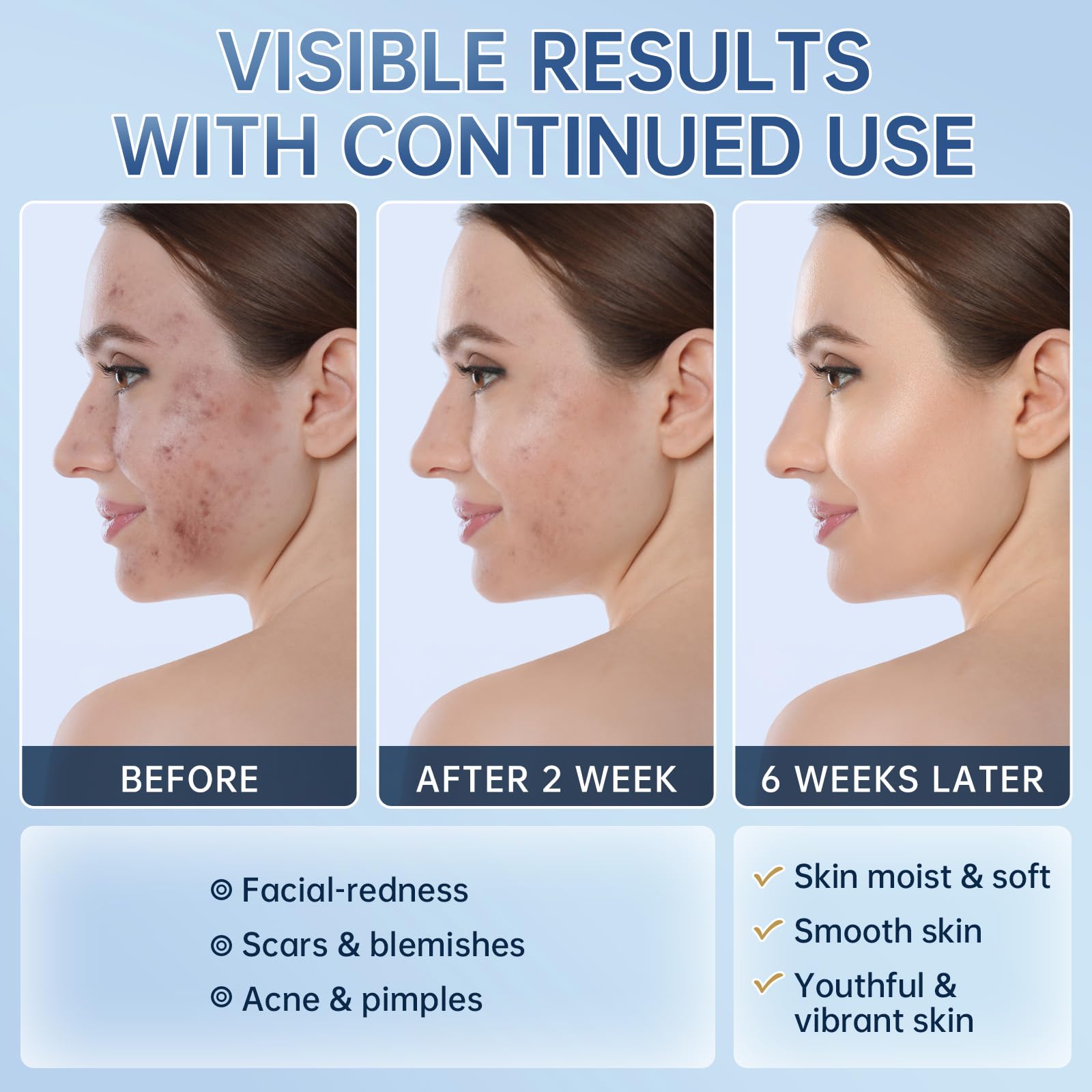 Mopayzer Azelaic Acid 14% Cream close-up promotes visible pore refinement