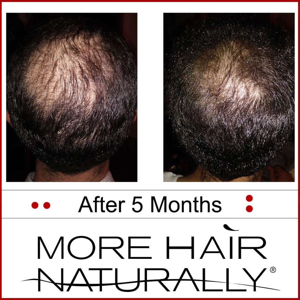 More Hair Naturally 9 clinical-strength formulation combines stem cells and botanicals.