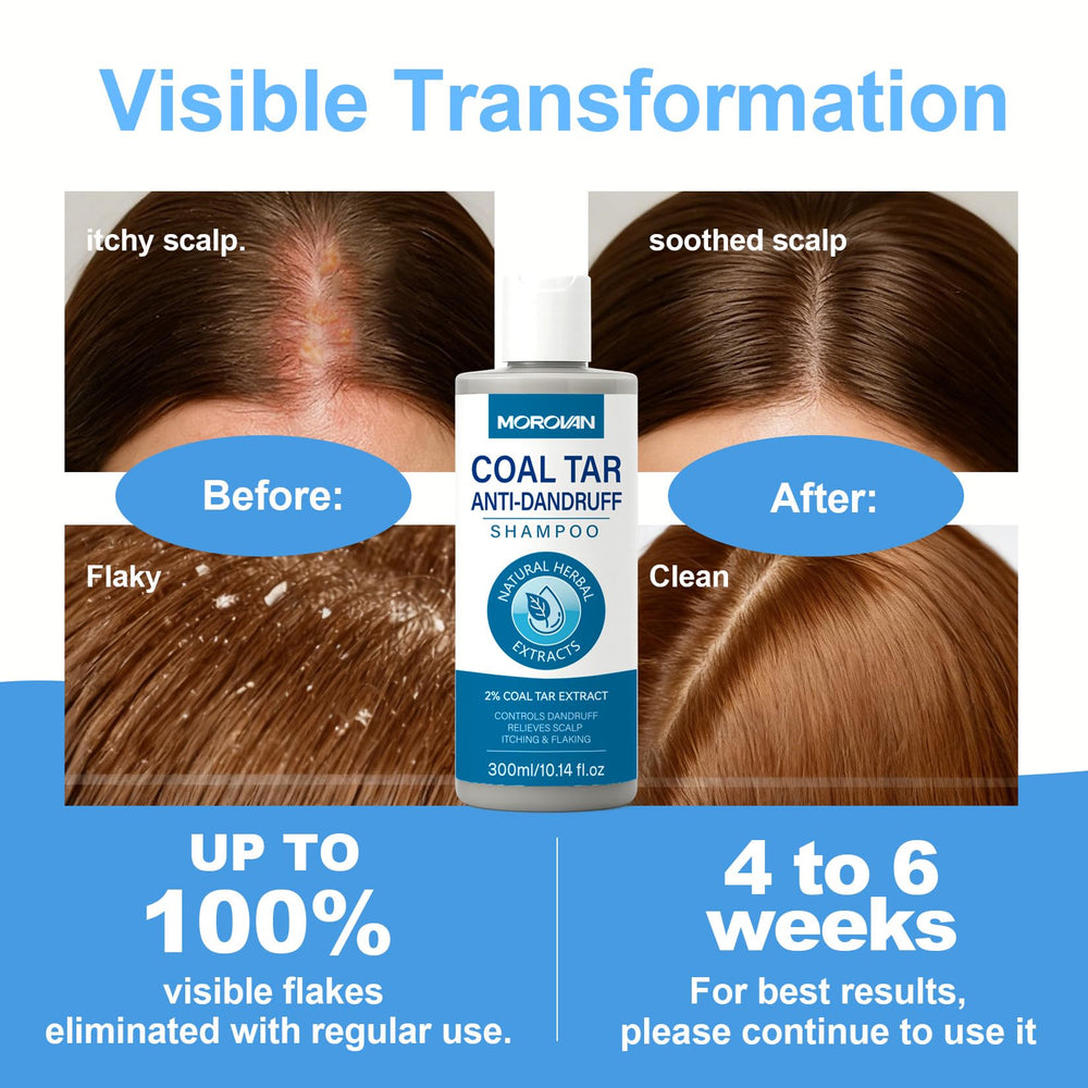 Morovan Coal Tar Shampoo in shower setup for convenient daily use.