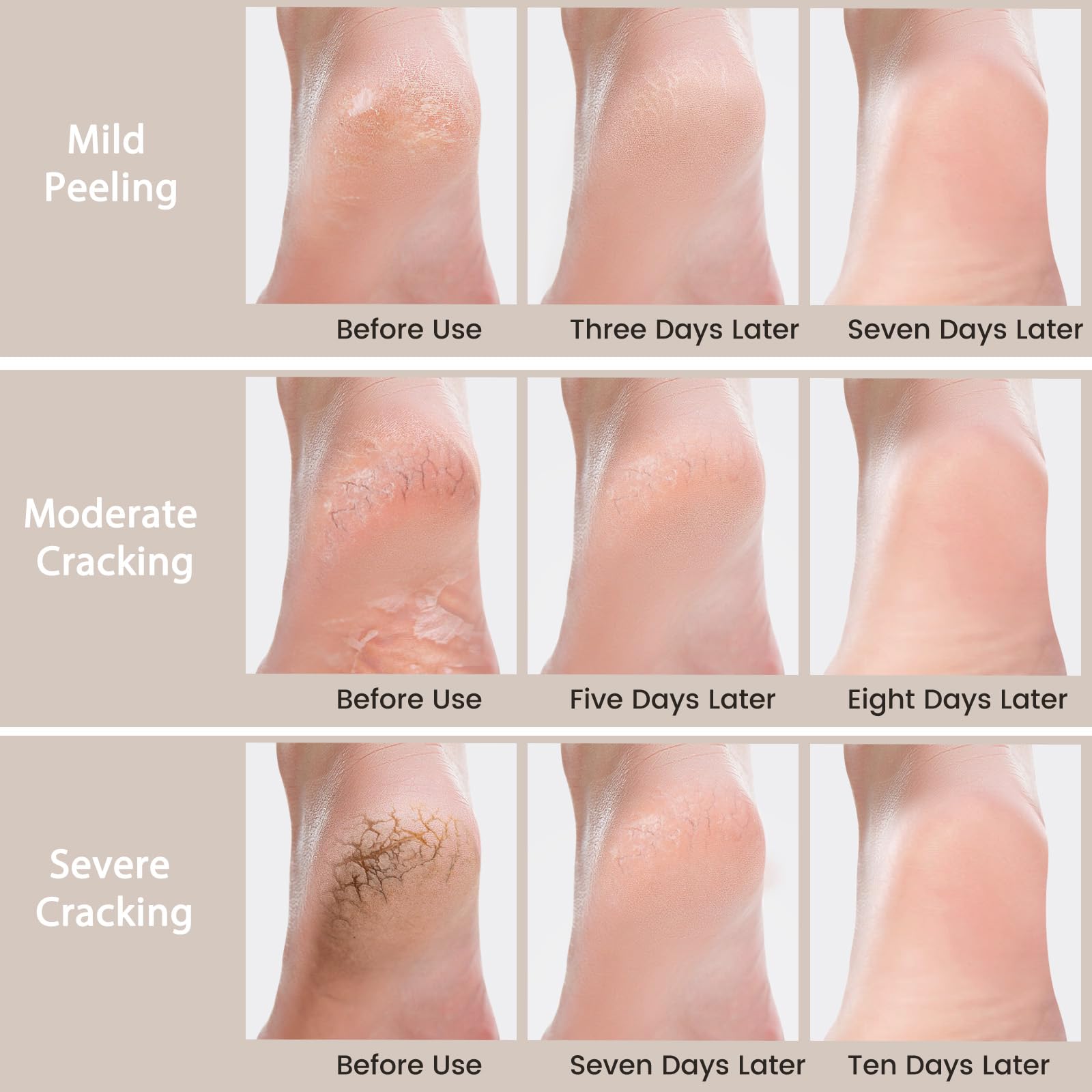 Mouriven Urea Cream 40% natural ingredients panel highlights glycerin, shea butter, jojoba oil