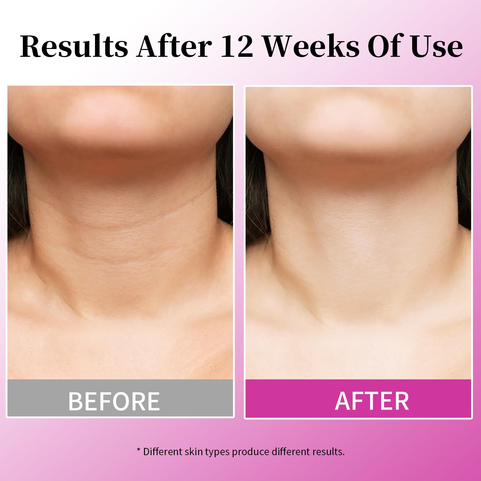 MRLILEI clinical results chart suggests texture and firmness improvements
