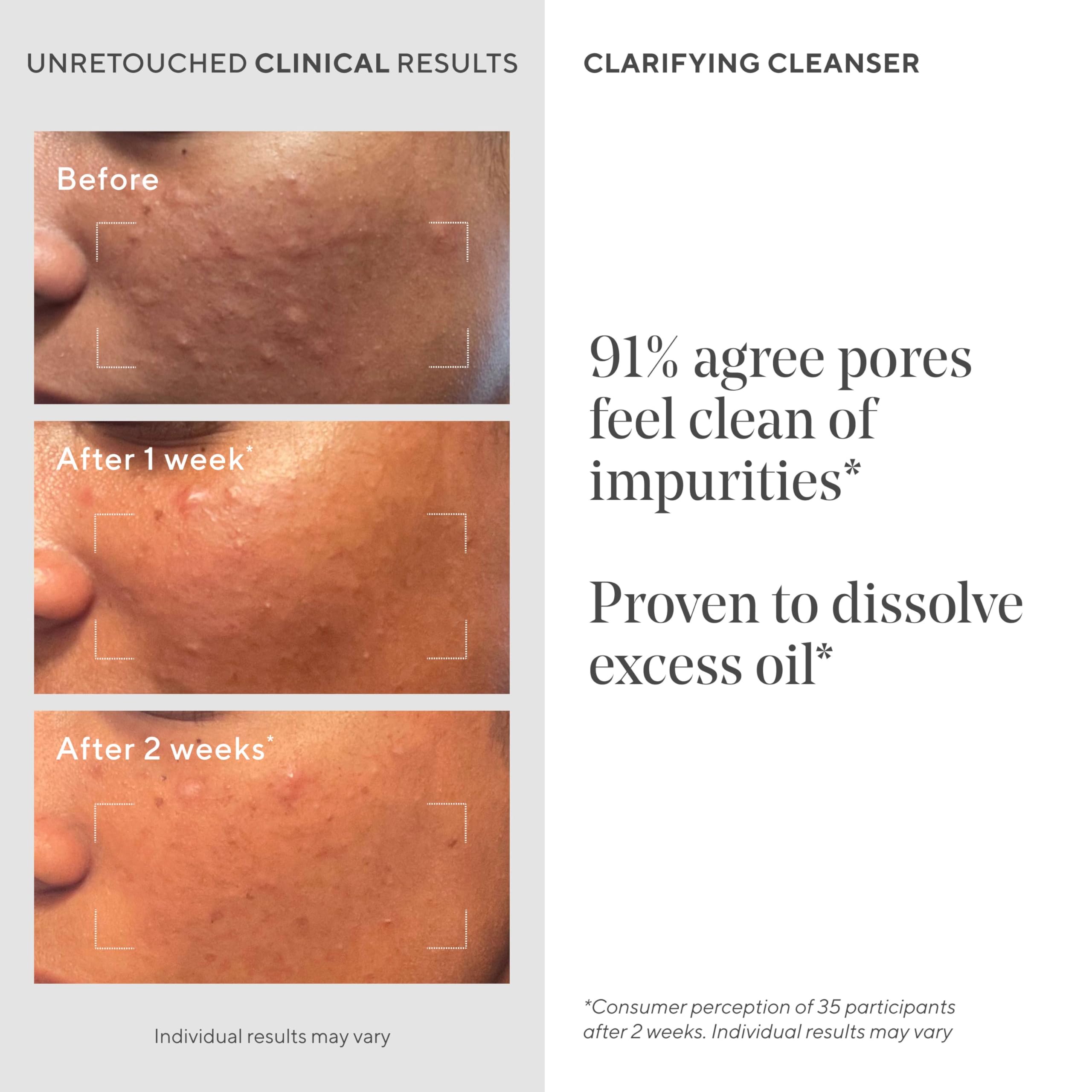 Close-up of pores before cleansing with Murad Acne Control Clarifying Cleanser.