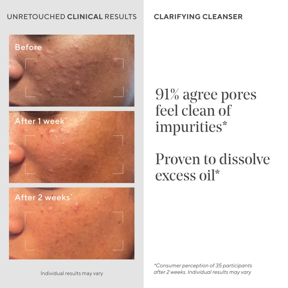 Close-up of pores before cleansing with Murad Acne Control Clarifying Cleanser.