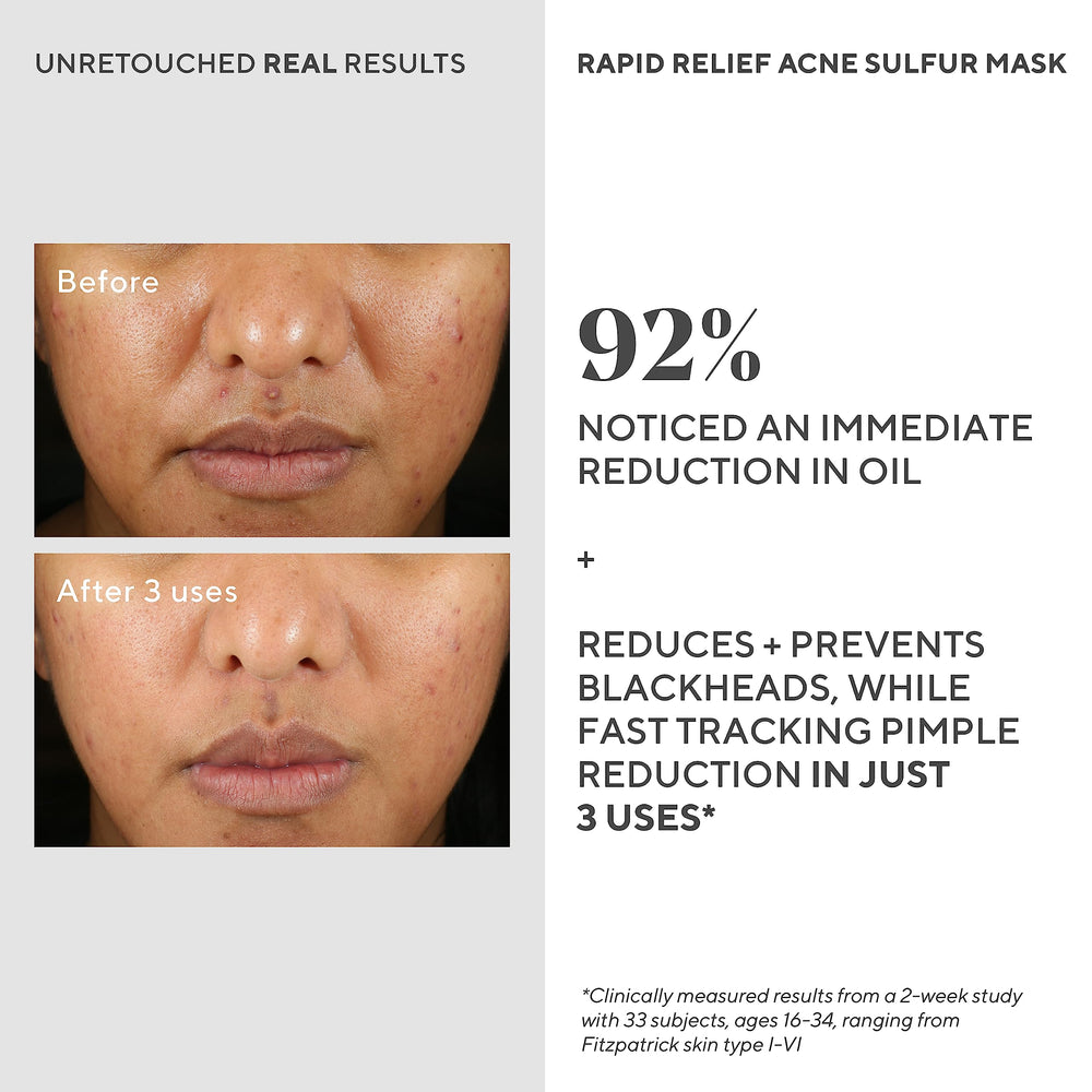 Murad Rapid Relief Acne Mask on clean skin before masking session.