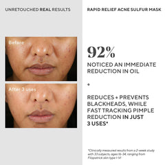 Murad Rapid Relief Acne Mask on clean skin before masking session.