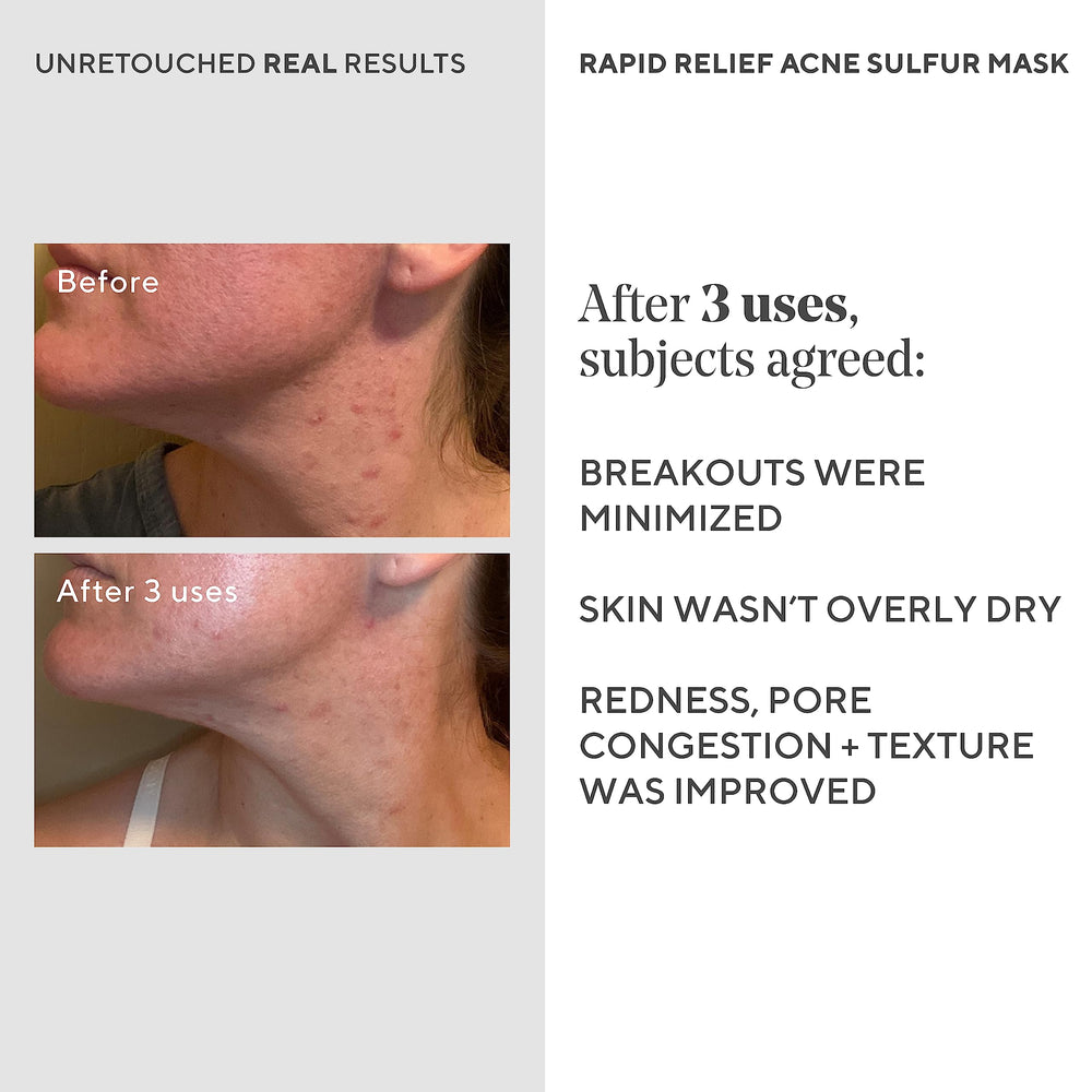 Murad Rapid Relief Acne Mask with sulfur-salicylic formula for blemish control.