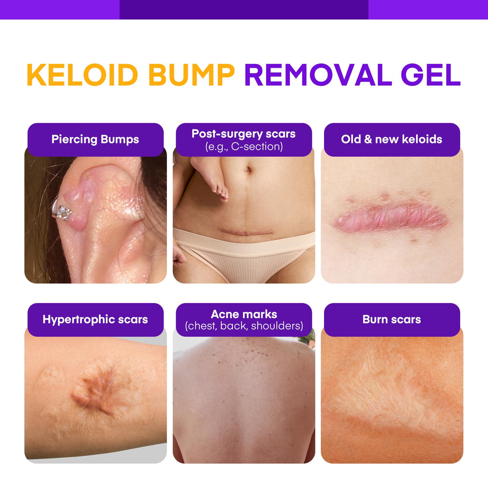 MURASAKI BEAUTY Keloid Bump Gel applied to the ear for gentle bump care
