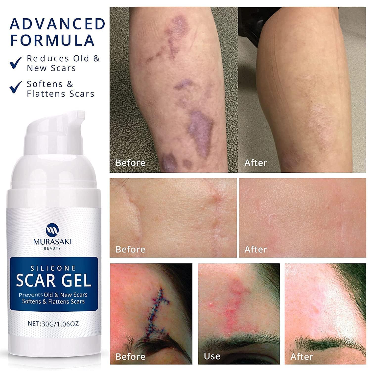 Murasaki Beauty precision applicator enables clean, mess-free scar application