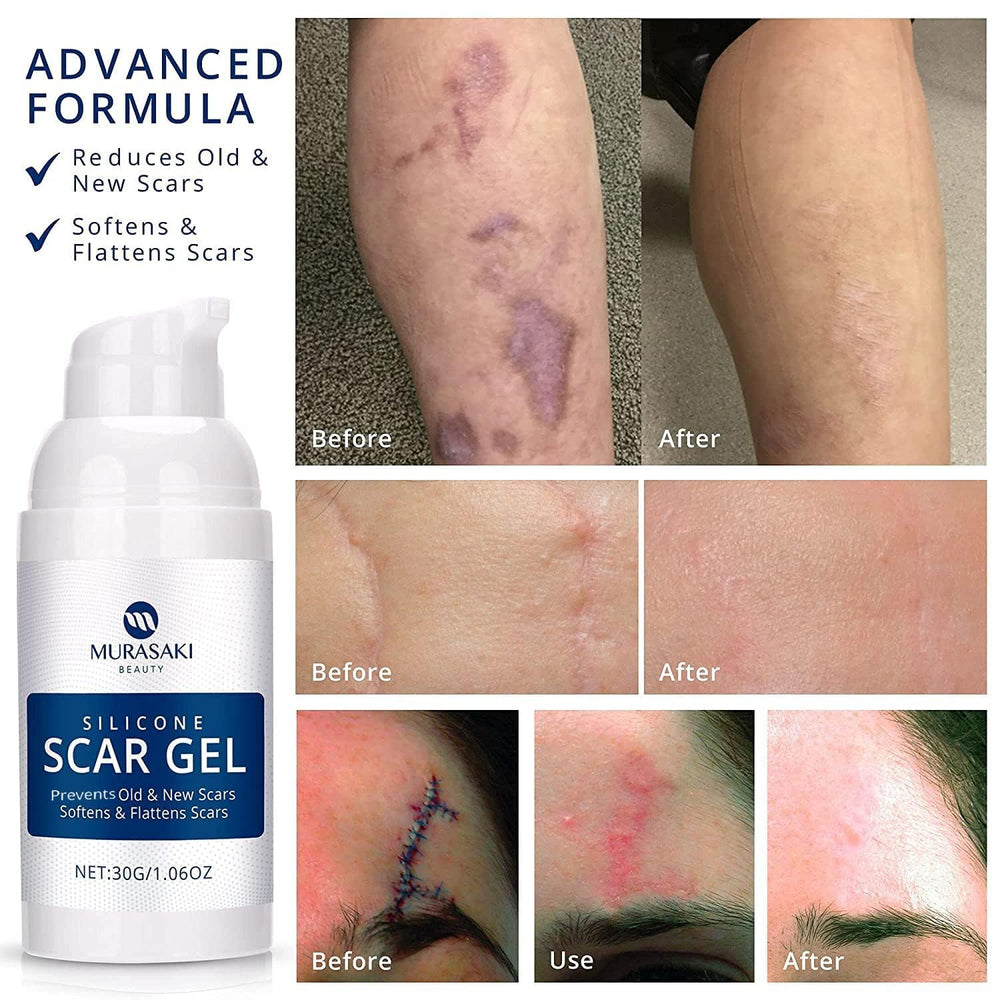 Murasaki Beauty precision applicator enables clean, mess-free scar application