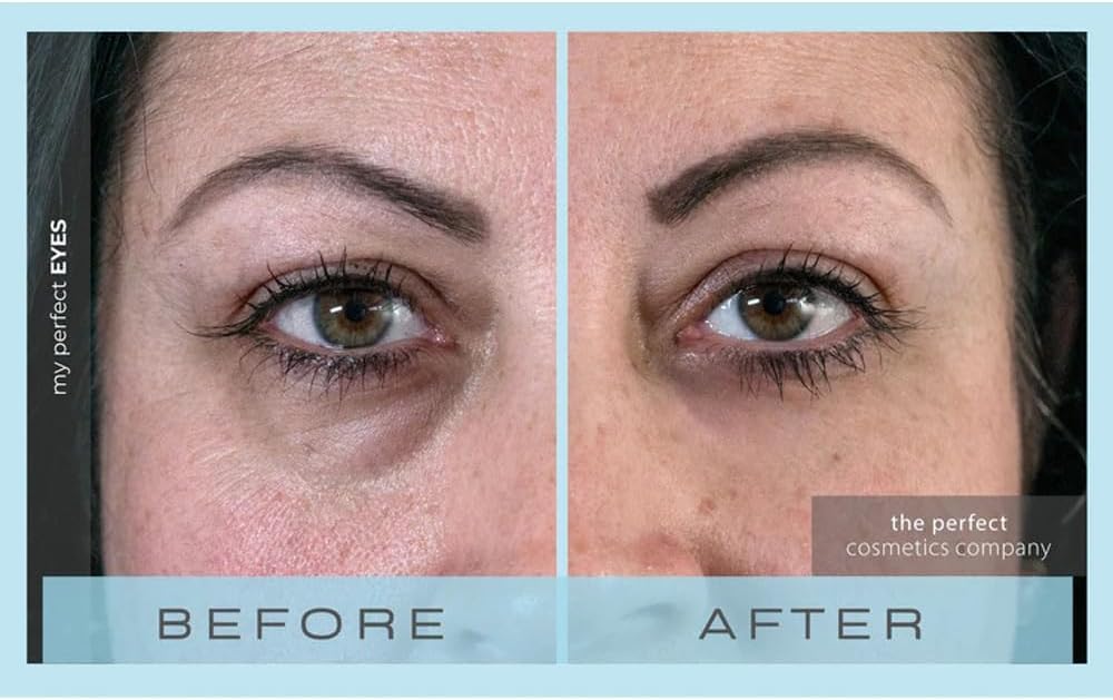 My Perfect Eyes puffiness reduction visual for awake eyes