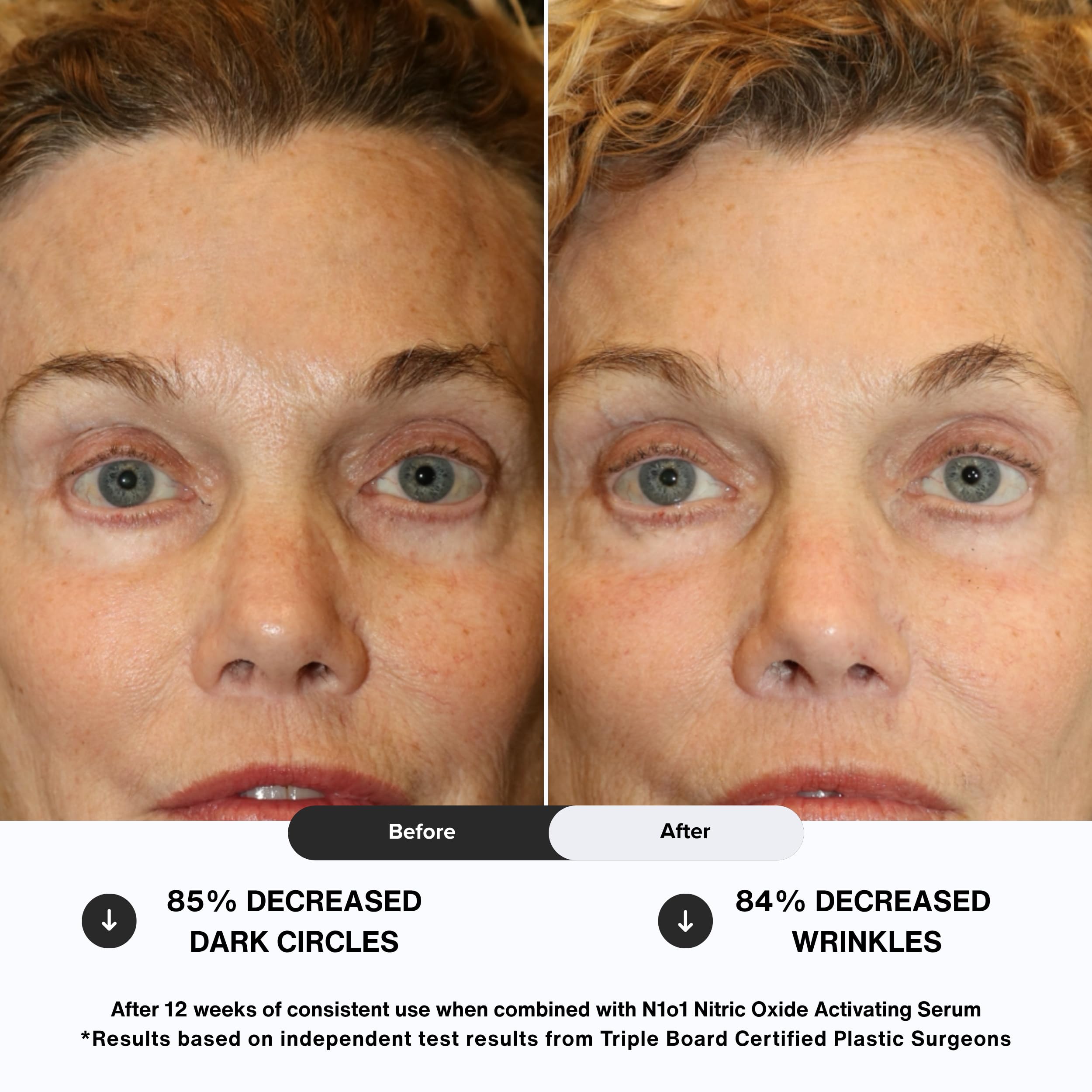 N1O1 Eye Cream addressing dark circles with brightening potential around the eyes.