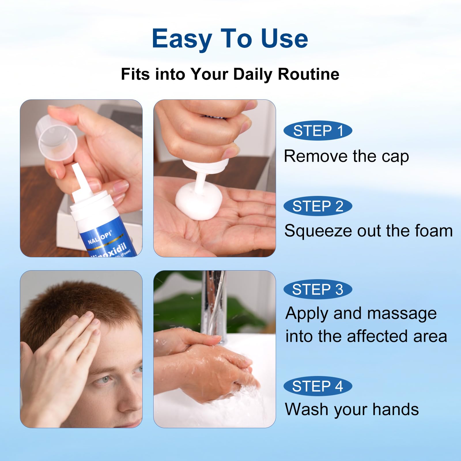 Beard area treated with minoxidil foam.