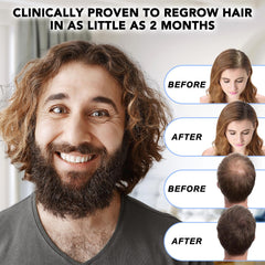 Nature Ziran Minoxidil for men targets thinning areas with daily use.