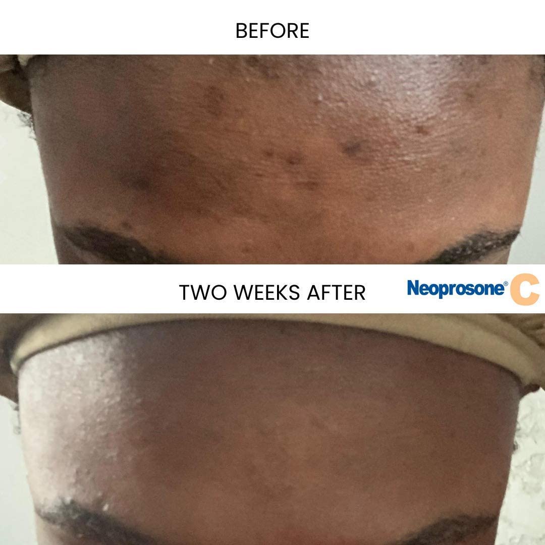 Neoprosone Vitamin C Serum close-up shows lightweight texture and quick absorption