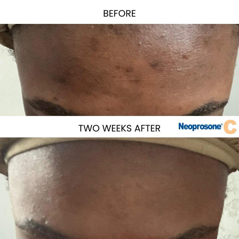 Neoprosone Vitamin C Serum close-up shows lightweight texture and quick absorption