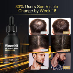 NETYIYUN scalp-spot application targets thinning edges with precision and care.