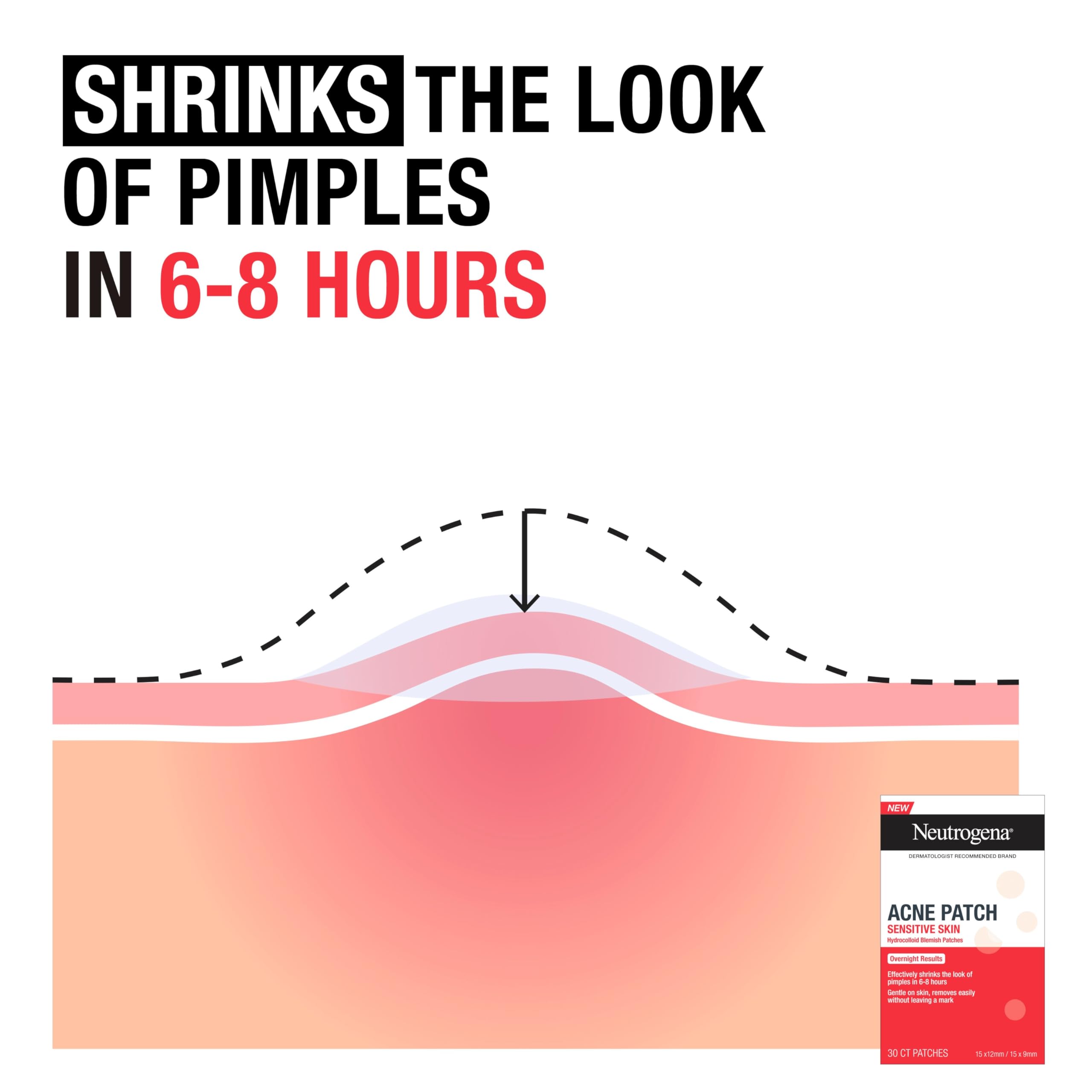 Neutrogena patches for overnight use on pimples