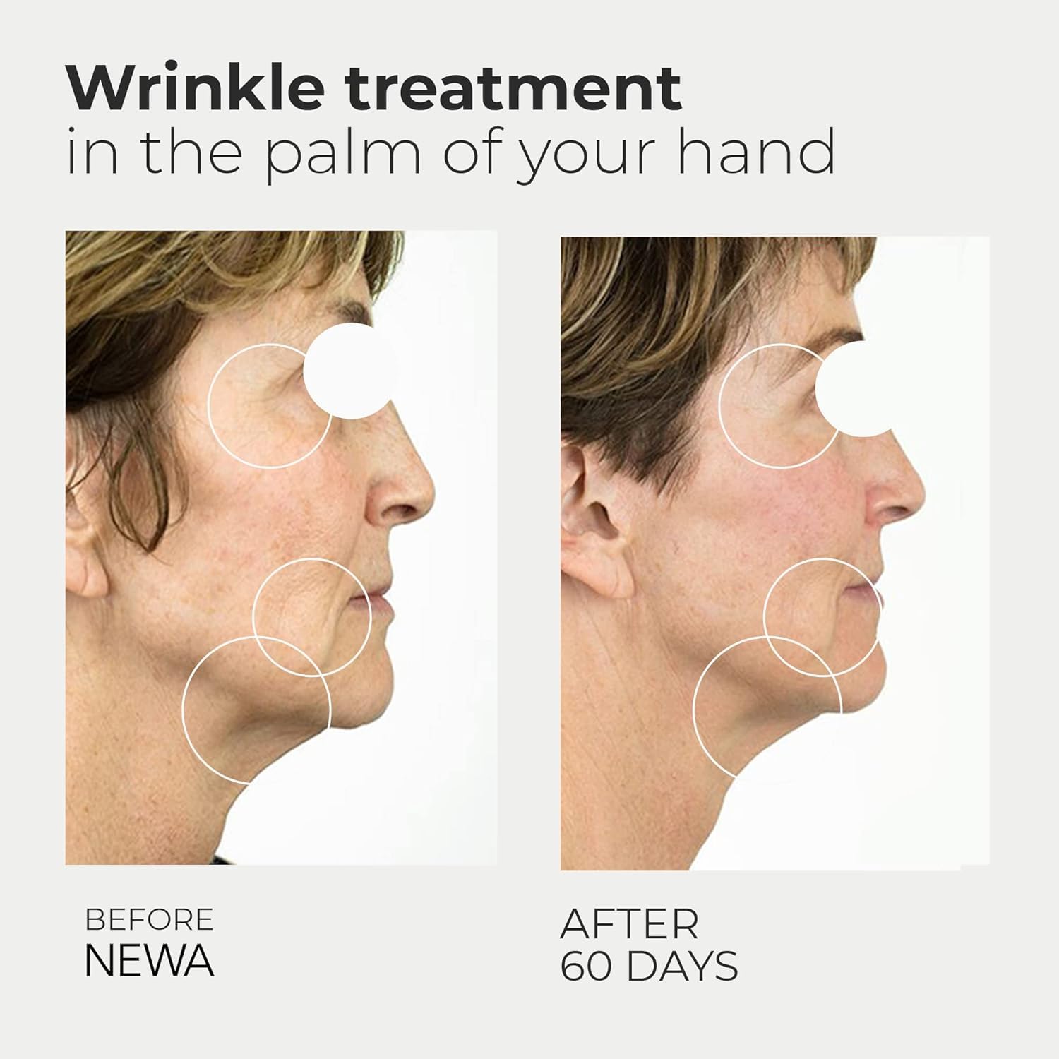 NEWA wrinkle device treatment session on the jawline for firmer skin.