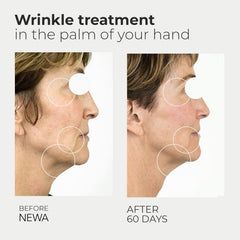 NEWA wrinkle device treatment session on the jawline for firmer skin.