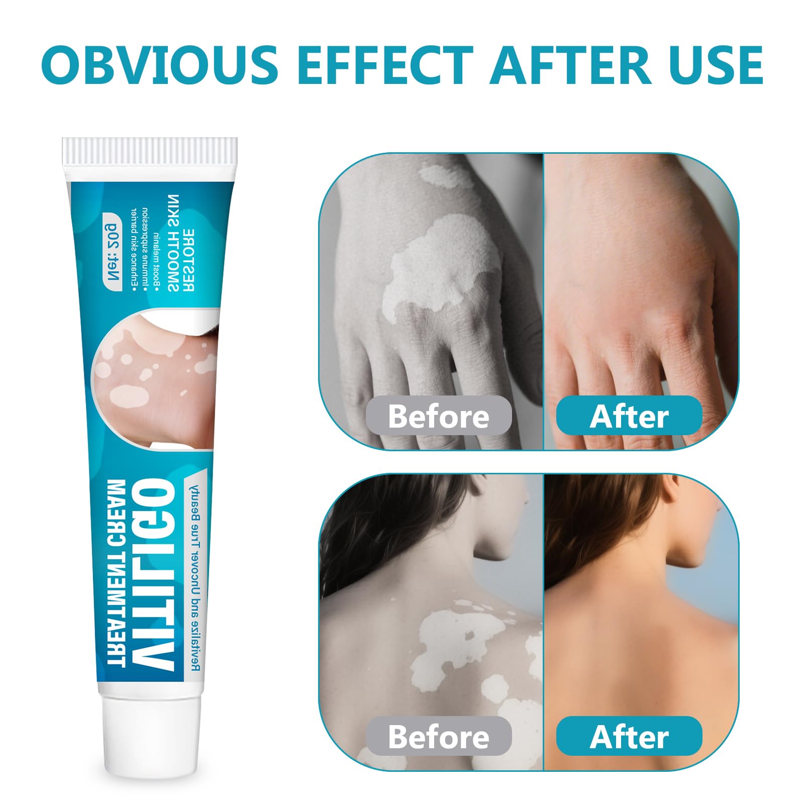 NHZ Vitiligo Cream bottle on vanity for daily use.