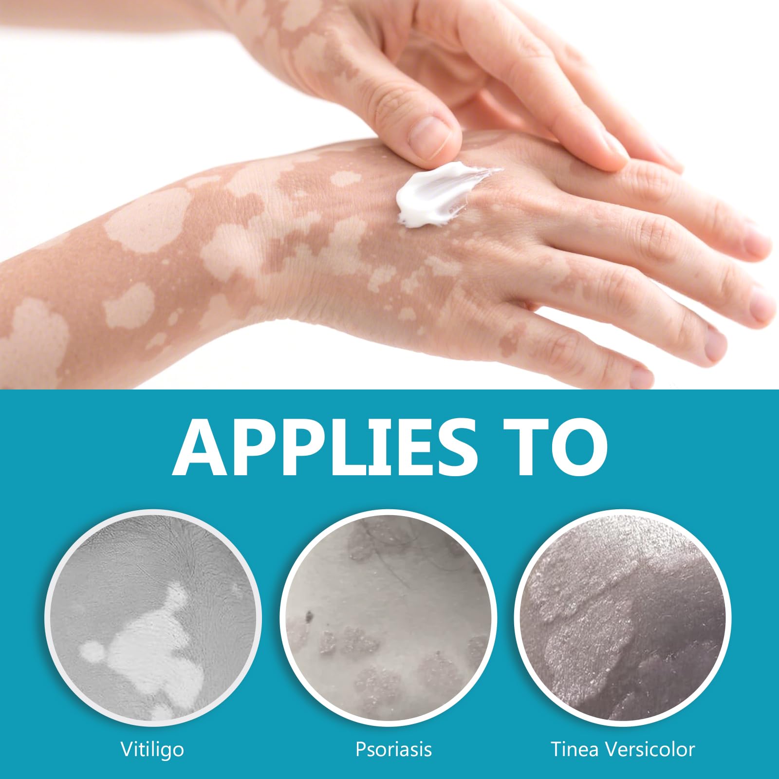 NHZ Vitiligo Cream compact 20g jar fits travel routines.