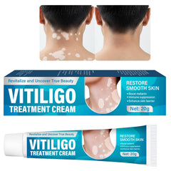 NHZ Vitiligo Cream targets white spots for a more even skin appearance.